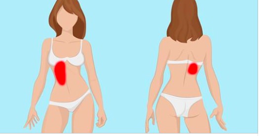 El del causar dolor ciático hematomas? nervio ¿Puede