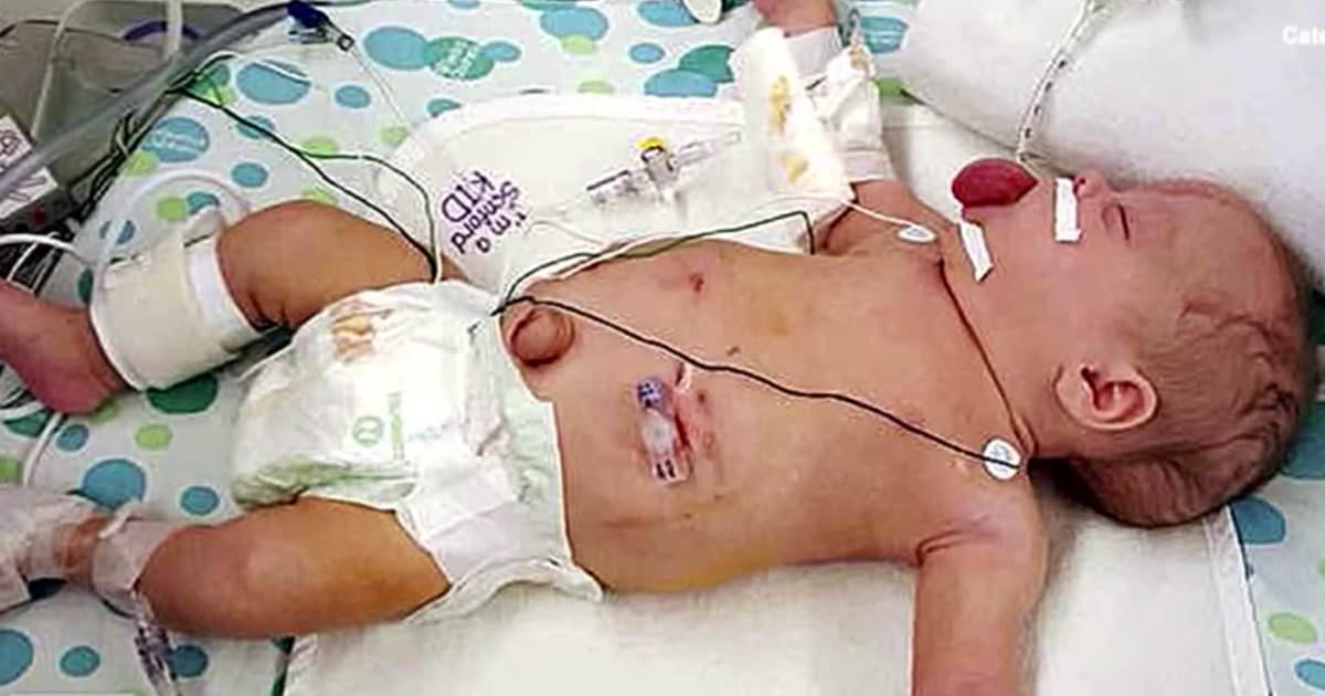 Bebe Nacida Con La Lengua Gigante Sonrie Por Primera Vez Despues De Una Exitosa Operacion