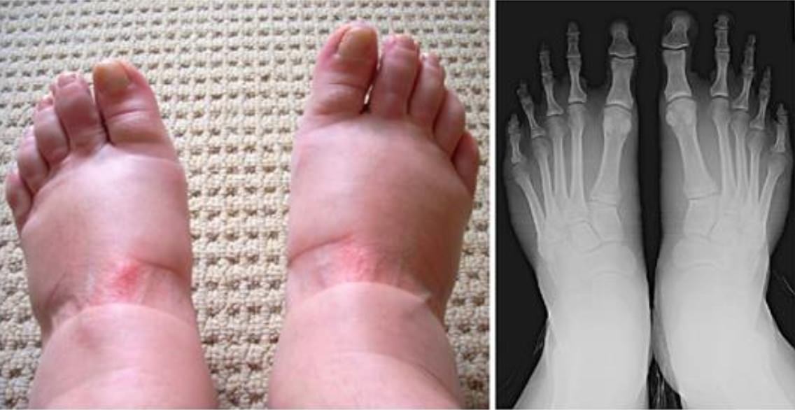 Dolor de piernas y pies hinchados