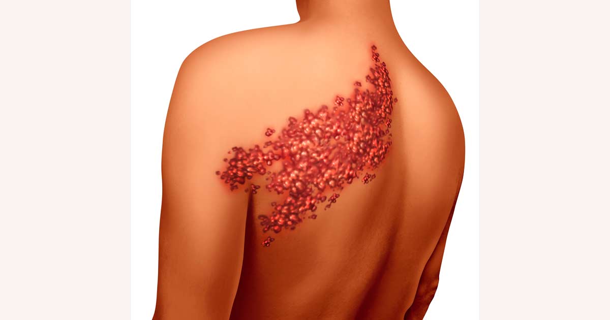 culebrilla