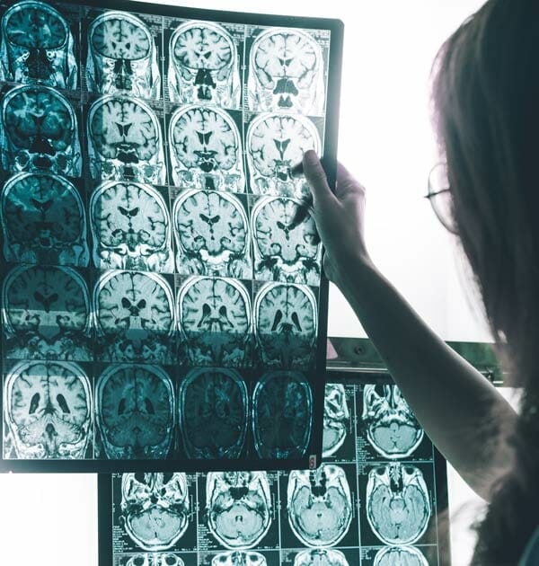 alzheimer