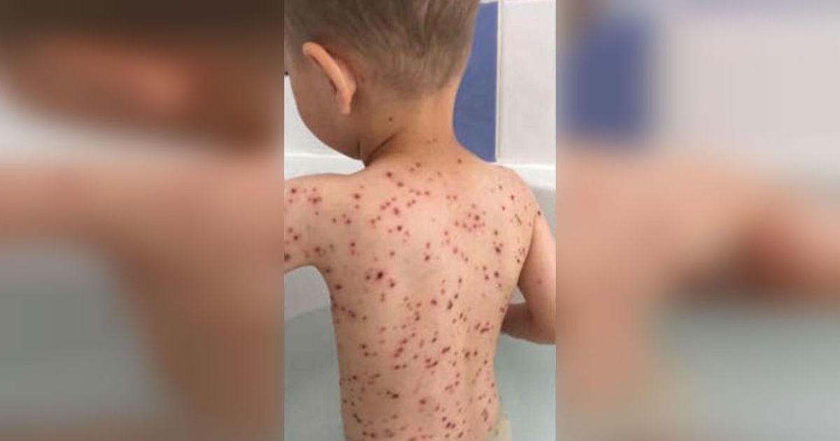 Why You Should NEVER Give Ibuprofen To A Child With Chickenpox.