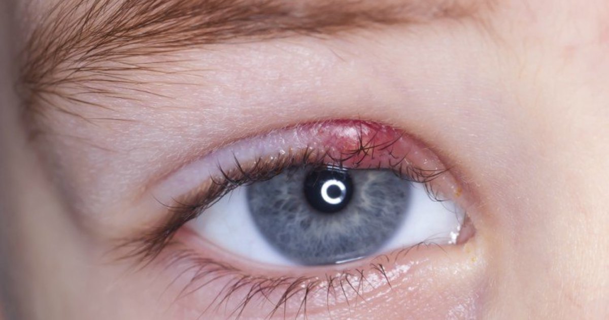 If you wake up and your eye looks like this – try these 10 household ...