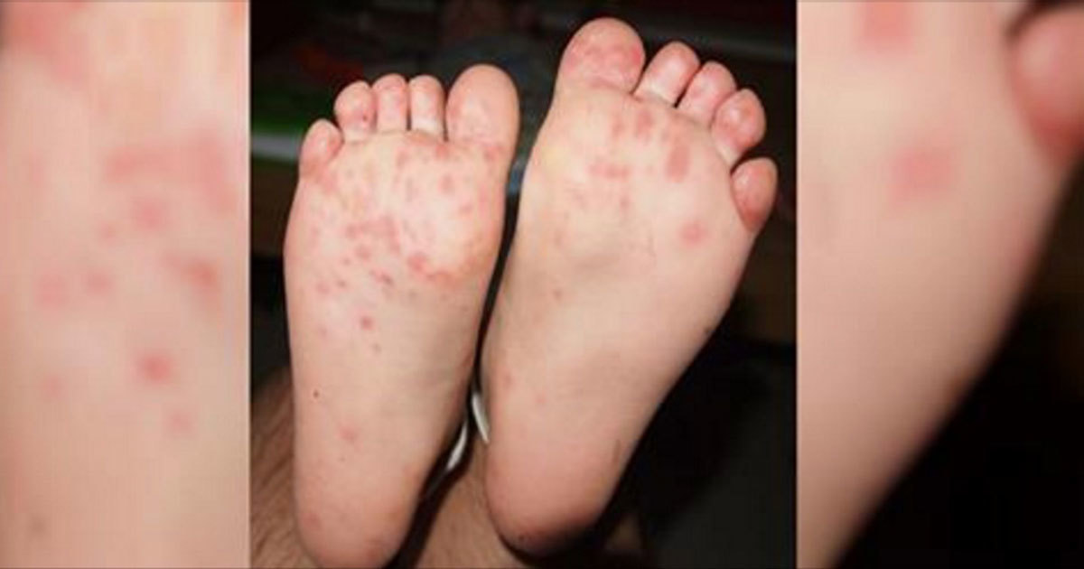 This Is The Season For Handfootandmouth Disease Do You Know The