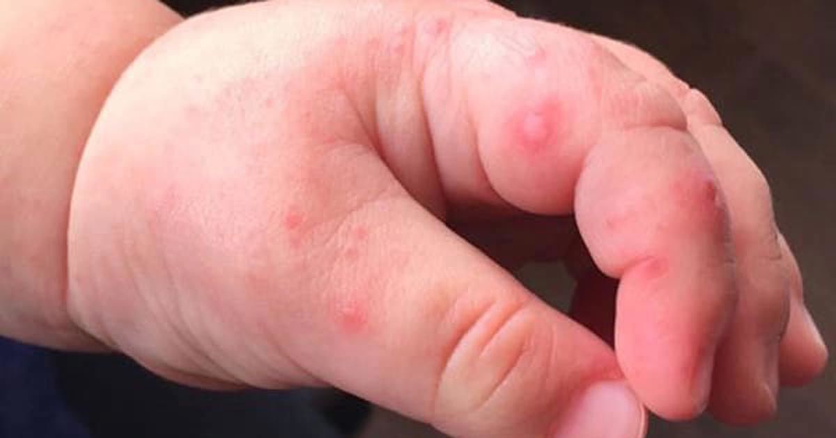 Red Blister Rash On Hands And Feet