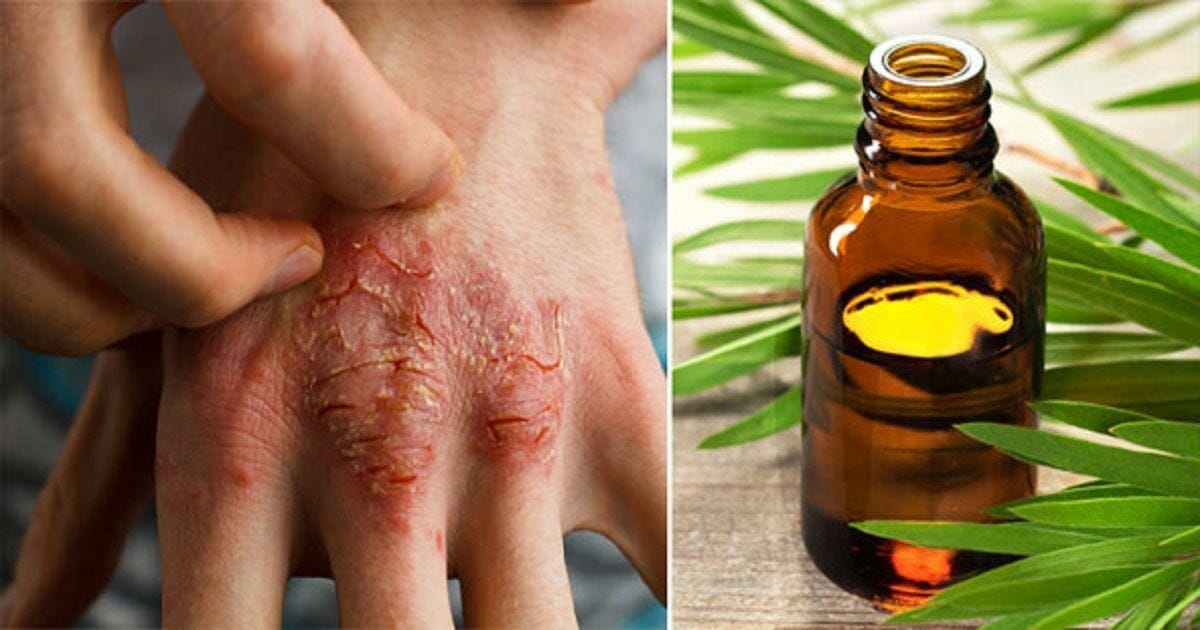 krijgen Kosmisch het spoor Tea tree oil: 7 fantastic uses you didn't know it had