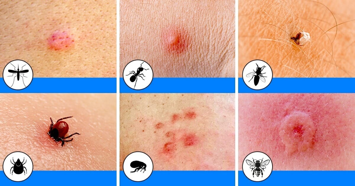 10-insect-bites-stings-that-you-should-learn-to-recognize-this-summer