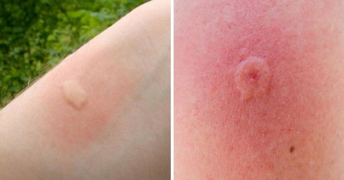 bee sting reaction