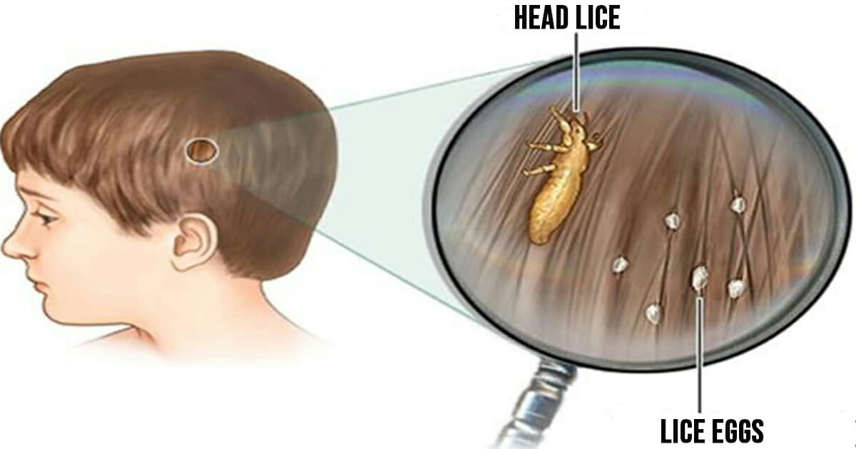 Head Lice How To Get Rid Of Them And Stop Them Coming Back