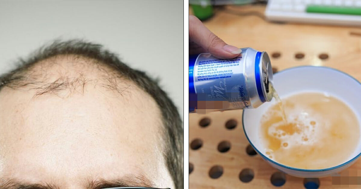 Washing your hair with beer can reduce dandruff and hair loss Washing your hair with beer can reduce dandruff and hair loss