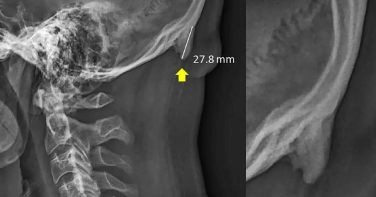 Study suggests cell phone use might cause development of