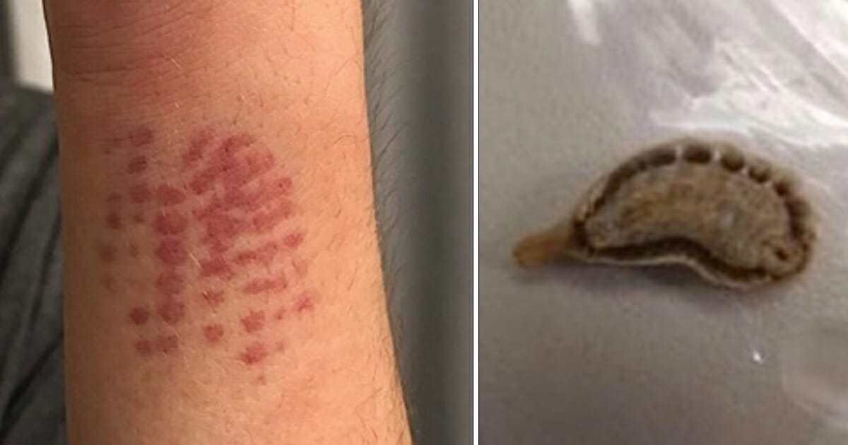 sick-teen-complains-of-strange-red-mark-on-his-arm-after-caterpillar-sting