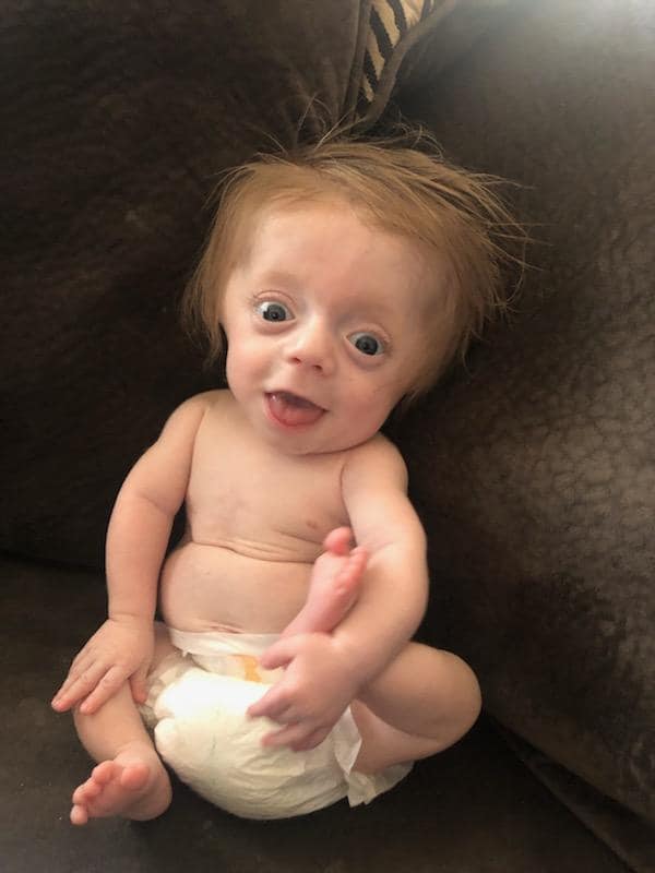 Newborn with Brittle Bone Disease diagnosis defies all odds to become ...