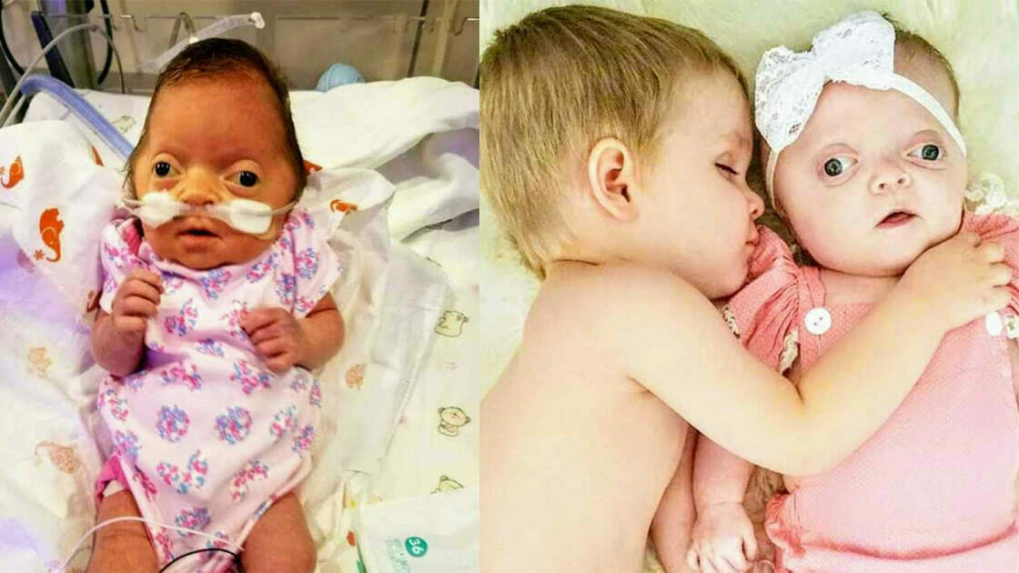 Newborn Baby Has Skull Removed And All Mom Sees Is A Perfect