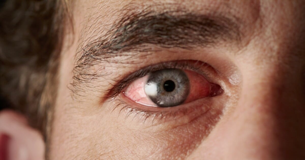 Pink eye could be rare symptom of COVID-19, according to ...