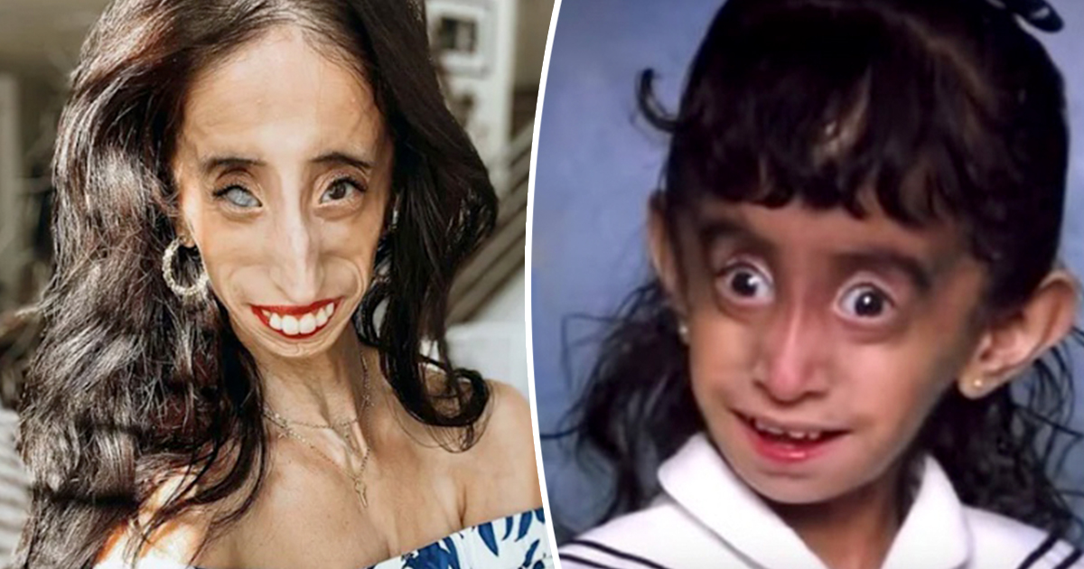 Lizzie Velasquez's life story – this is her today, at 31