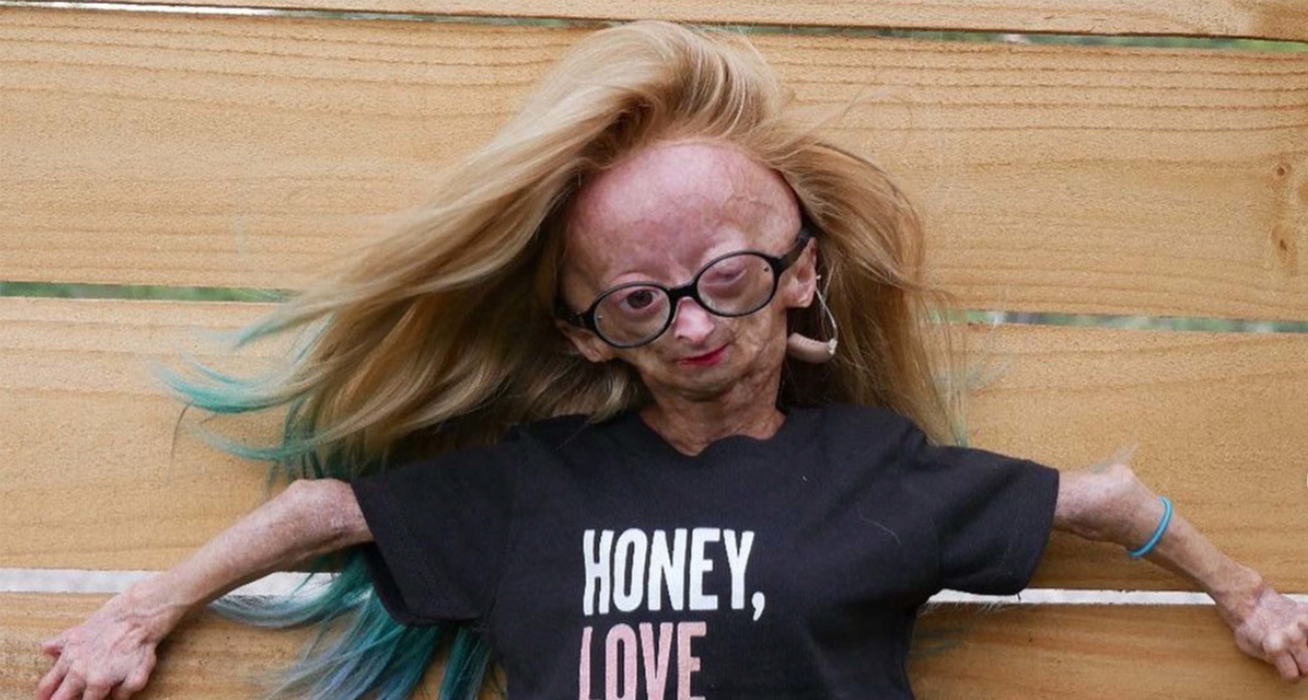 Adalia Rose Williams The Girl With Rare Early Aging Syndrome Inside Her Life 