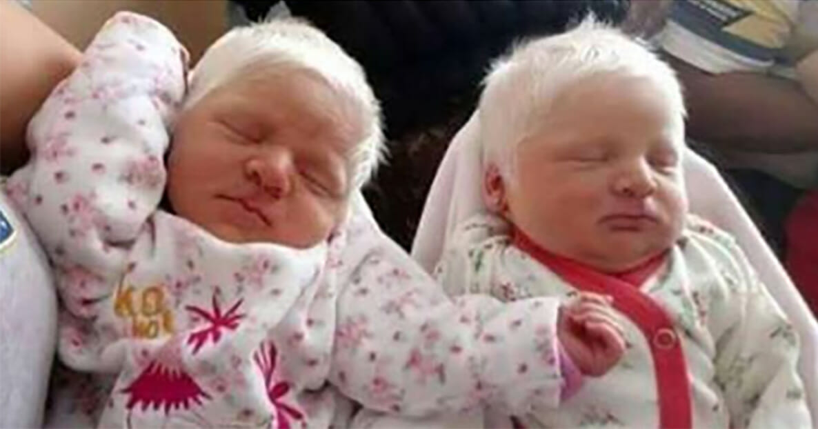 Mom gives birth to rare albino twins with snow-white hair