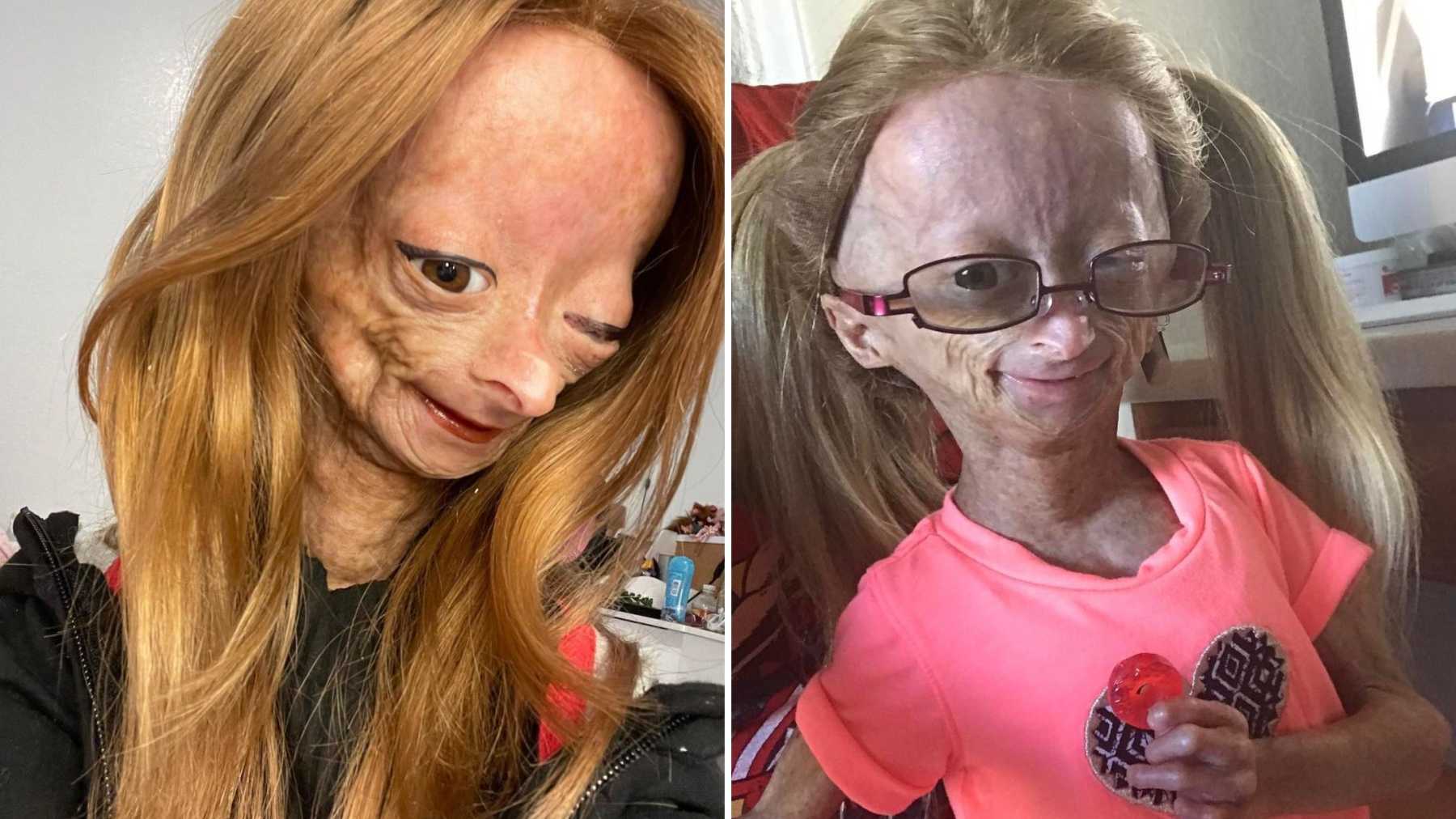 Adalia Rose Williams – the girl with rare Early-Aging syndrome: Inside