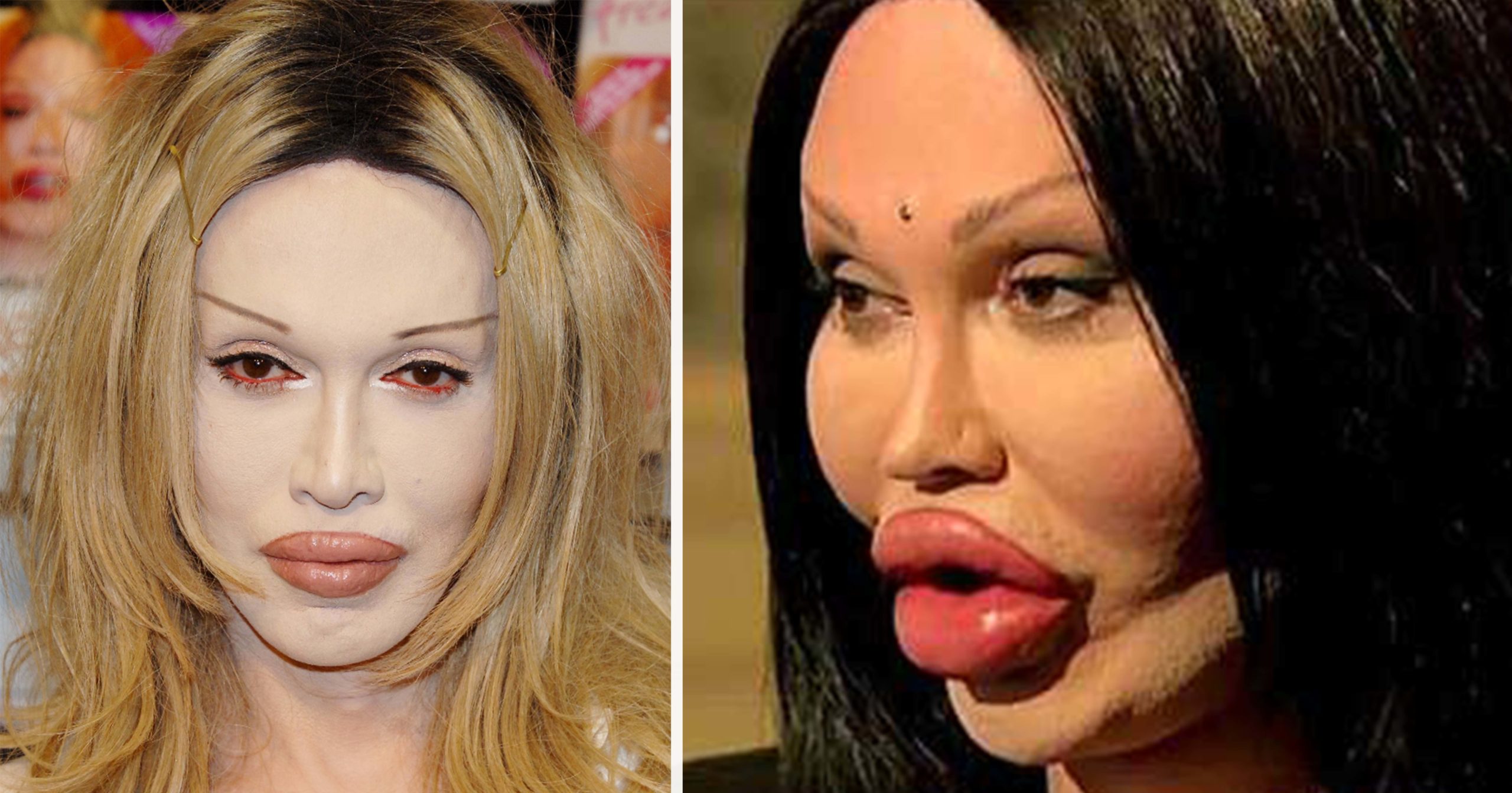 Pete Burns endured over 300 cosmetic surgeries on his face and it