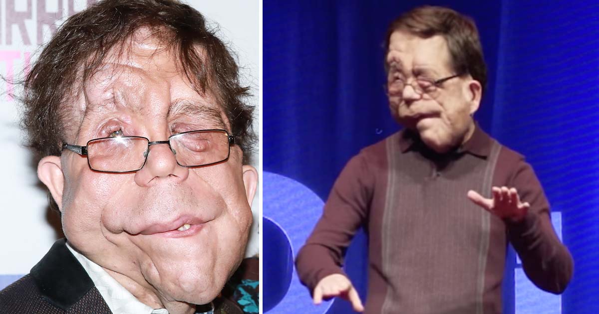 The incredible story of Adam Pearson: He became a movie star despite his genetic disorder