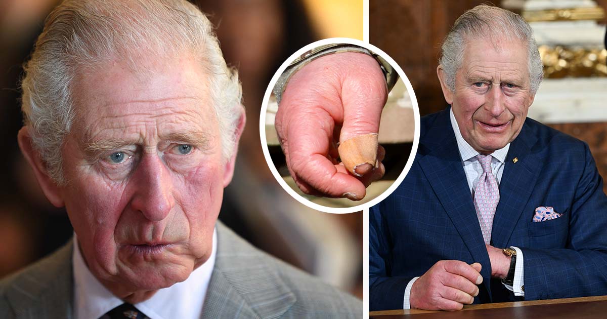 King Charles' 'sausage fingers' mystery solved as doctor shares medical  explanation - Irish Mirror Online
