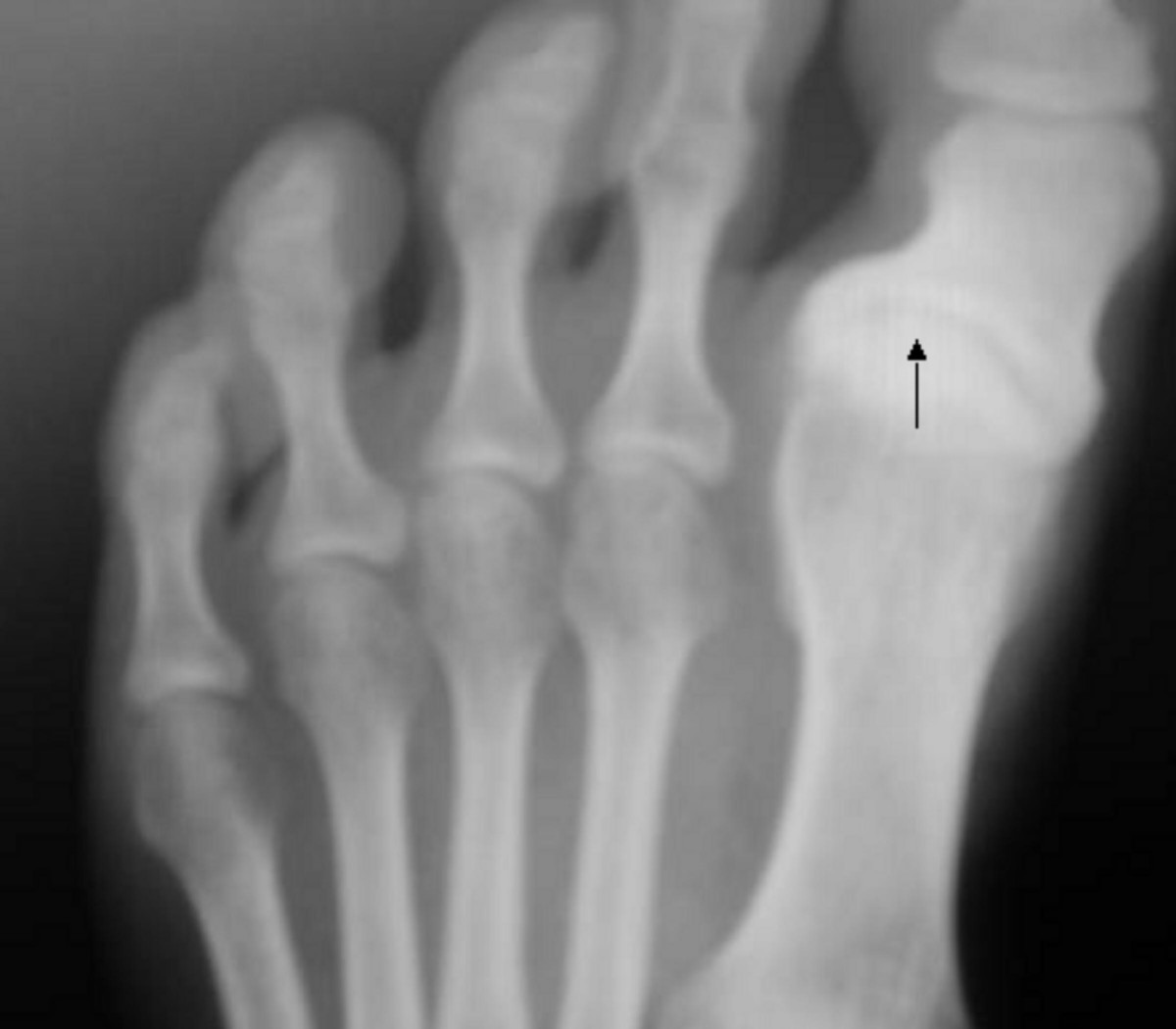 Piede per osteoartrite