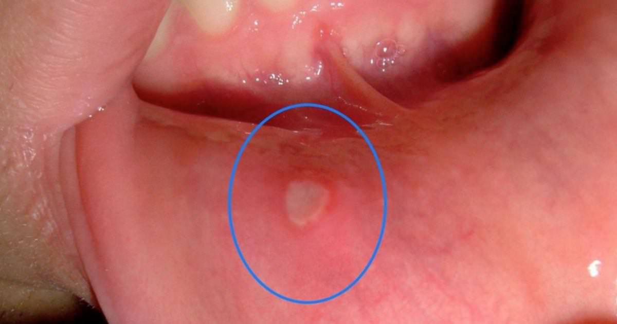 svampinfektion i munnen behandling