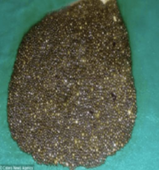 gallstenar