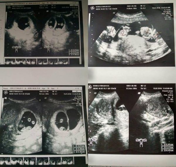 The graphic shows ultrasound pictures of quintuplets