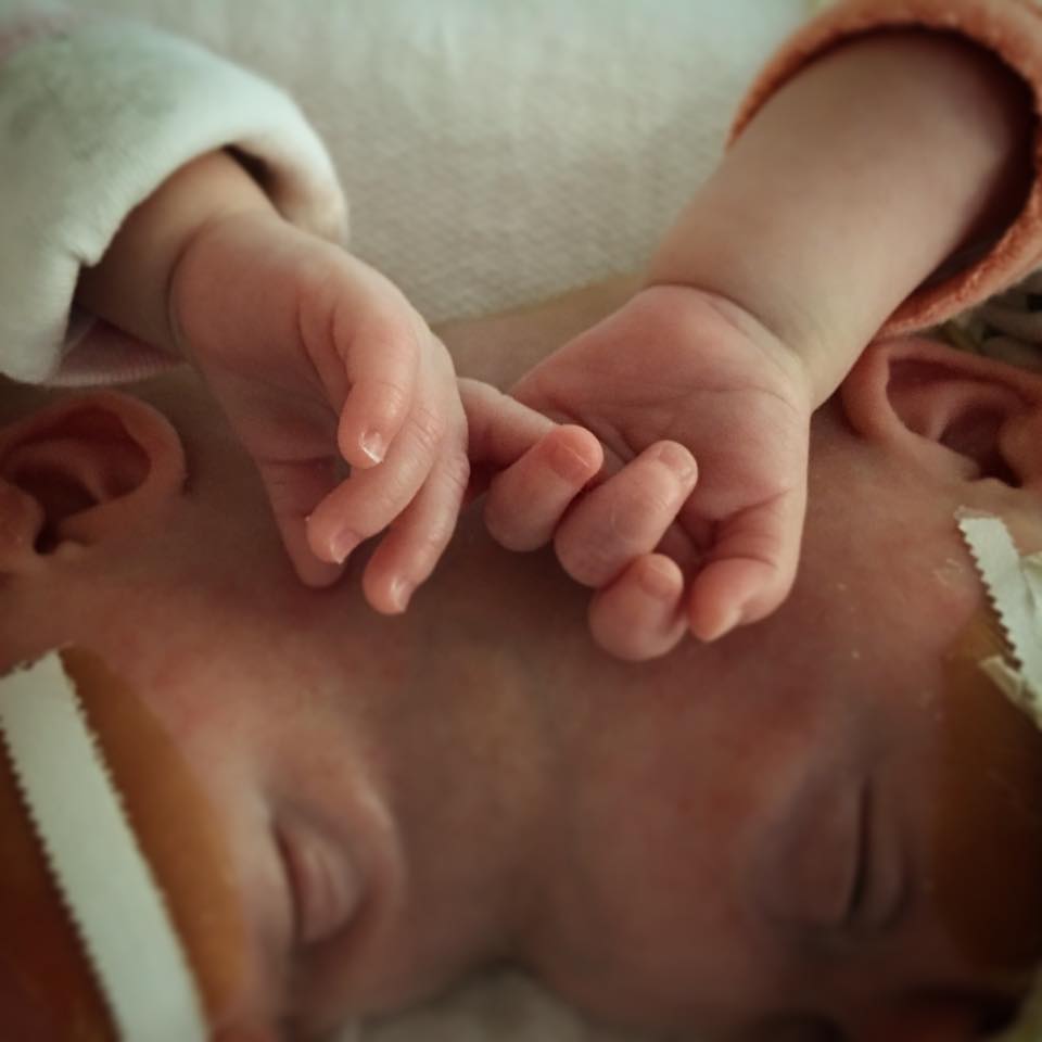 noworodki zrośnięte głowami trzymają się za ręce