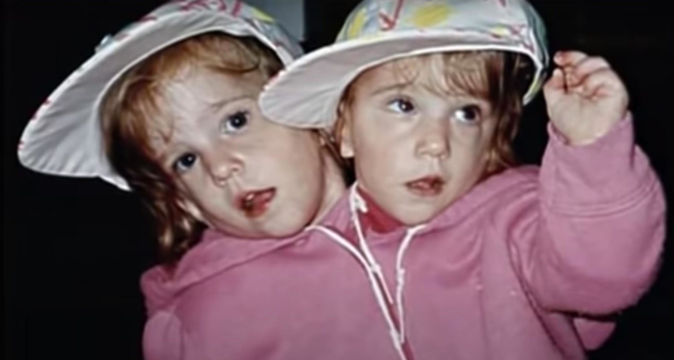 bliźniaczki syjamskie w różowej bluzie i białych czapeczkach z daszkiem