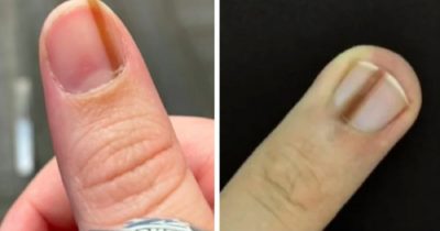 Gdy zauważysz taką kreskę na paznokciu niezwłocznie udaj się do lekarza - ta decyzja może uratować ci życie