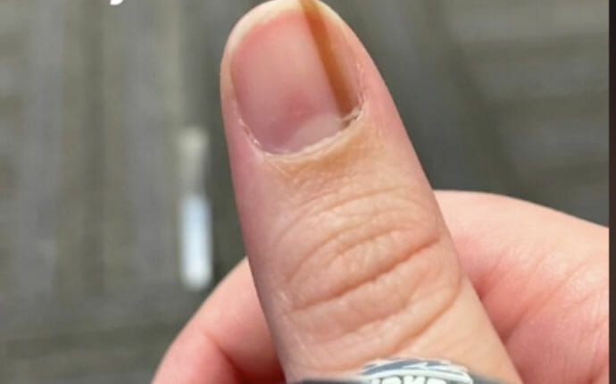 kciuk z paznokciem na którym jest brązowy pasek