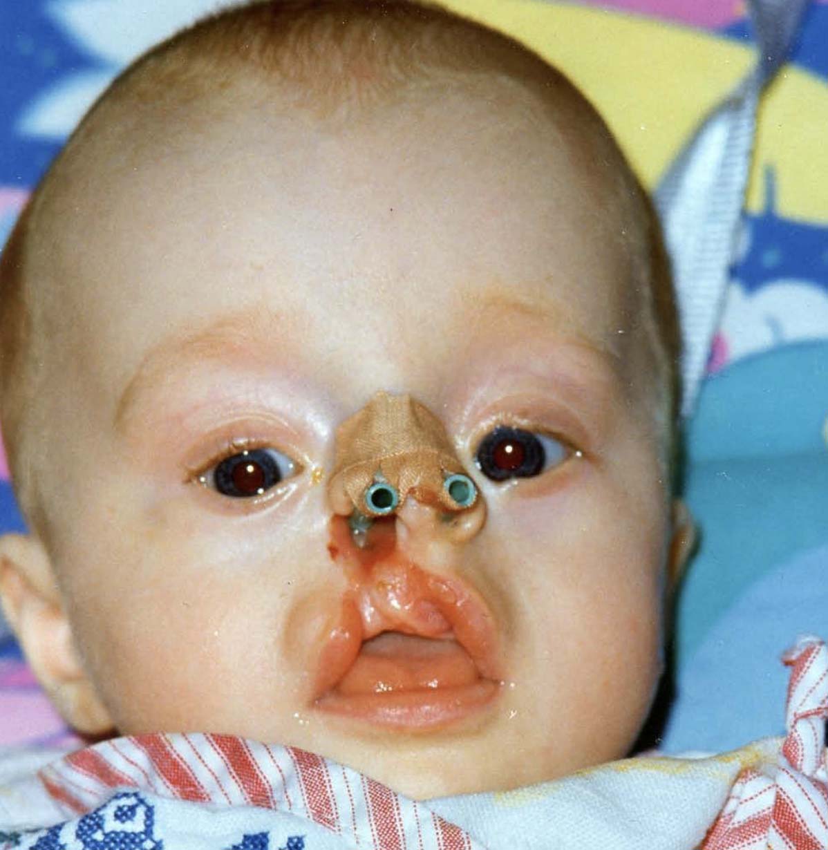 dziecko z deformacją wargi i nosa