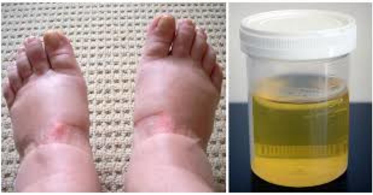 10 merkkiä vaarallisesta virtsarakon syövästä, jotka jokaisen naisen