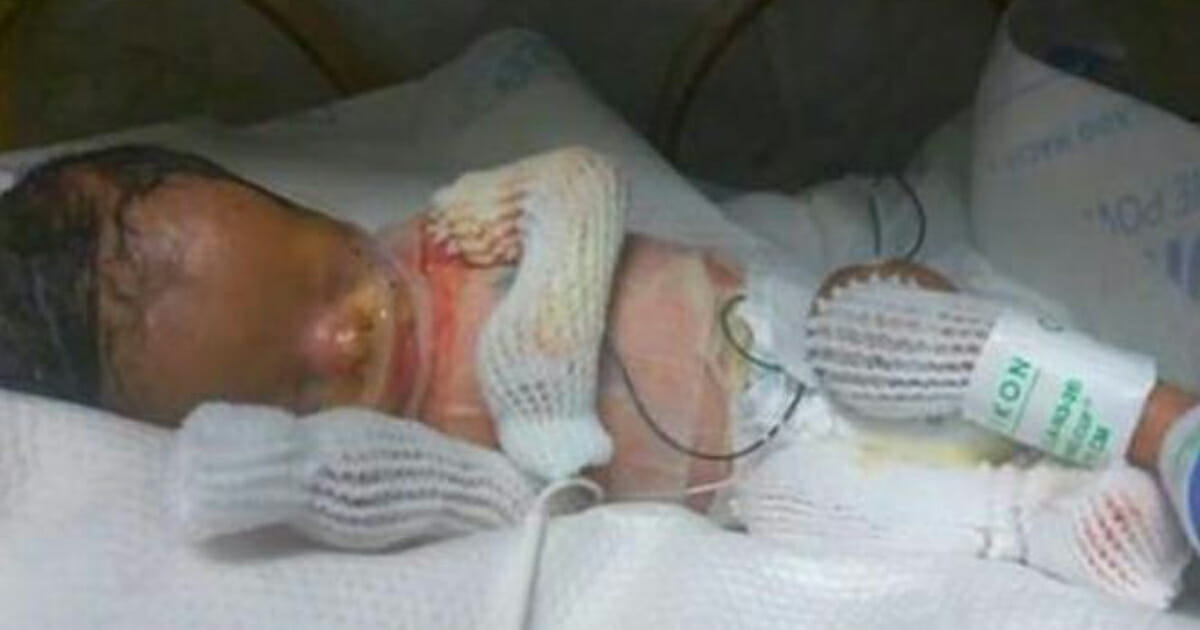 Esitellä 12+ imagen vauva syntyi ilman ihoa