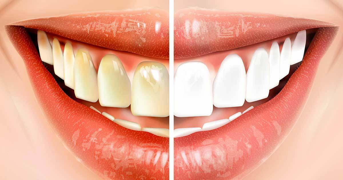 Gør dette før du børster tænder – og spar masser af penge tandlægeregninger