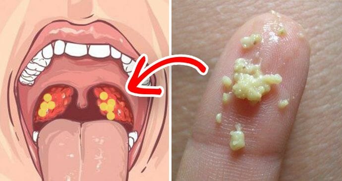 alarmerende symptomer på tonsillitter som aldrig bør ignoreres