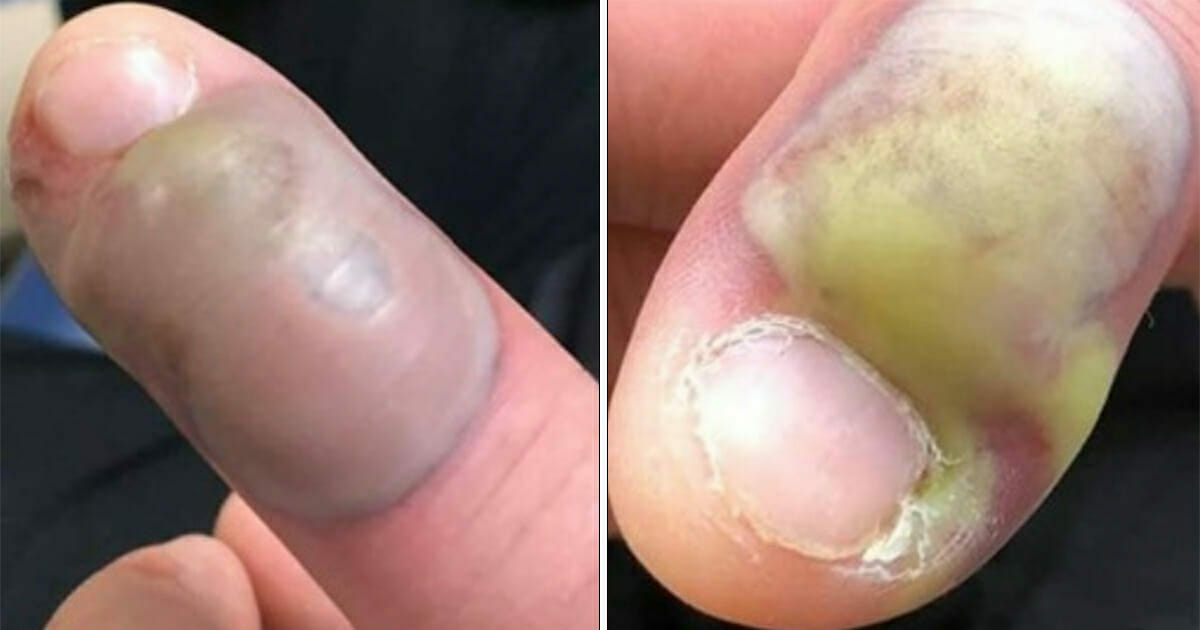 Kvinde får dødelig infektion og hastes på sygehuset – nu advare andre mod bide negle