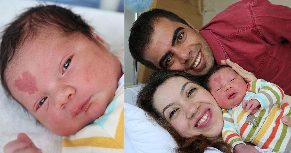 Baby mit einzigartigem Muttermal bezaubert die ganze Welt.