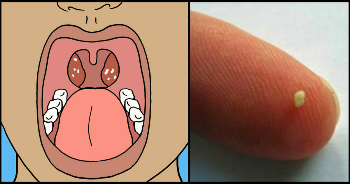 Inflamadas en amigdalas ninos tratamiento