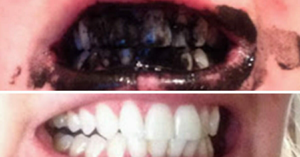 Antibiotica plakband zuur Top tip: Poets je tanden met geactiveerde houtskool om hen wit te maken