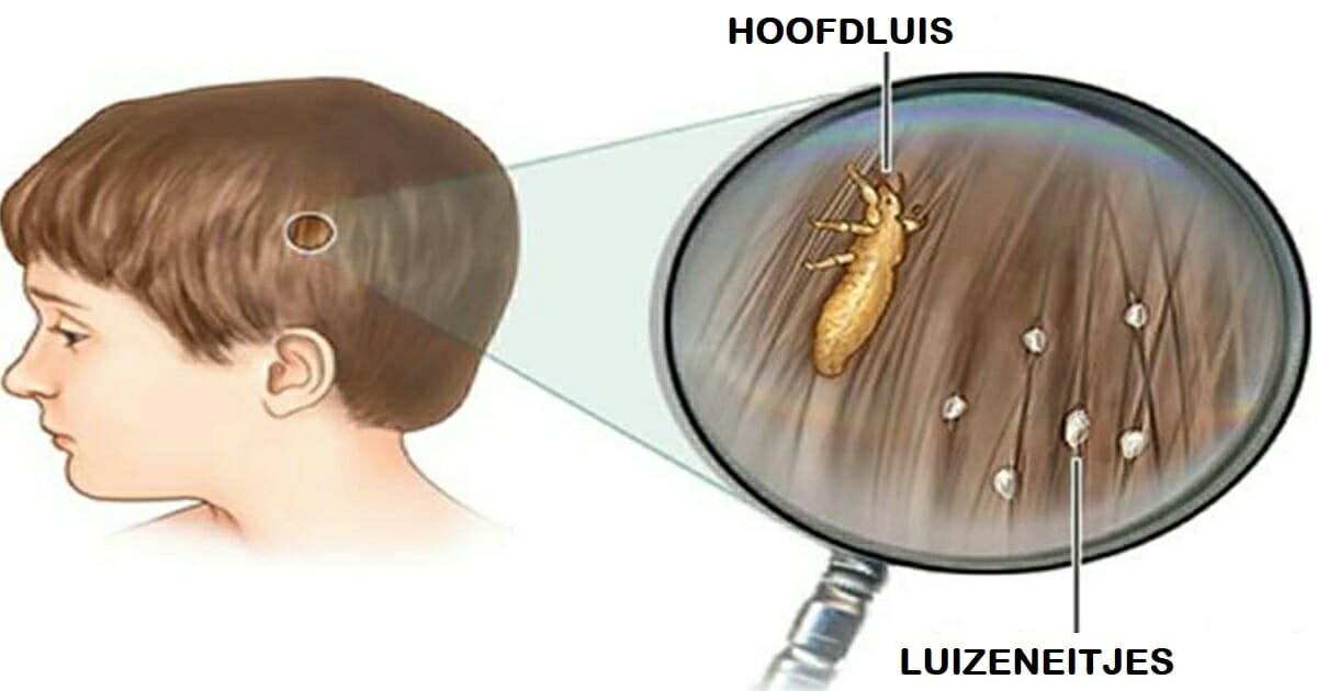 Hoofdluizen Hoe Ermee Komaf Maken En Vermijden Dat Ze Terugkeren