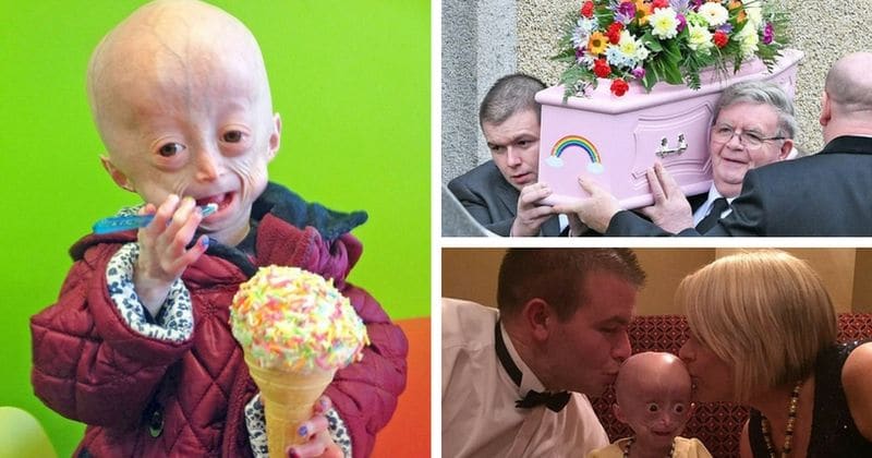 Cette Fille Vieillit 10 Fois Plus Rapidement Que Ses Autres Amis Et Meurt A L Age De 8 Ans Le Monde Entier Est En Deuil Maintenant