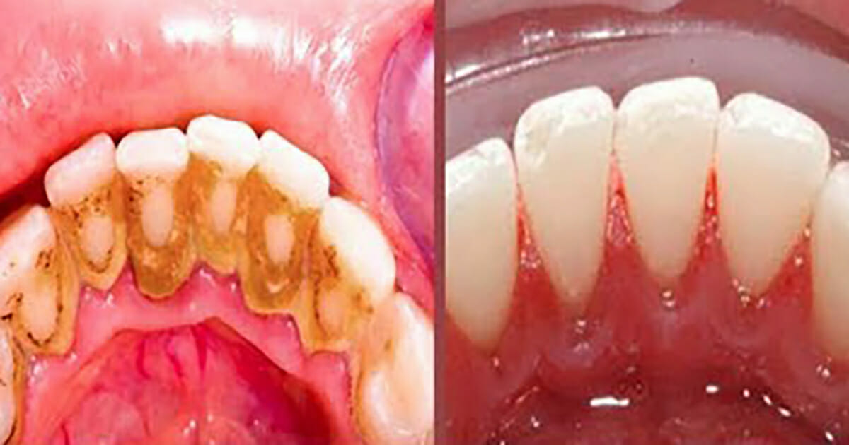 Détartrer Les Dents Remède De Grand-mère Plaque dentaire : Voici une astuce de grand-mère toute simple qui vous