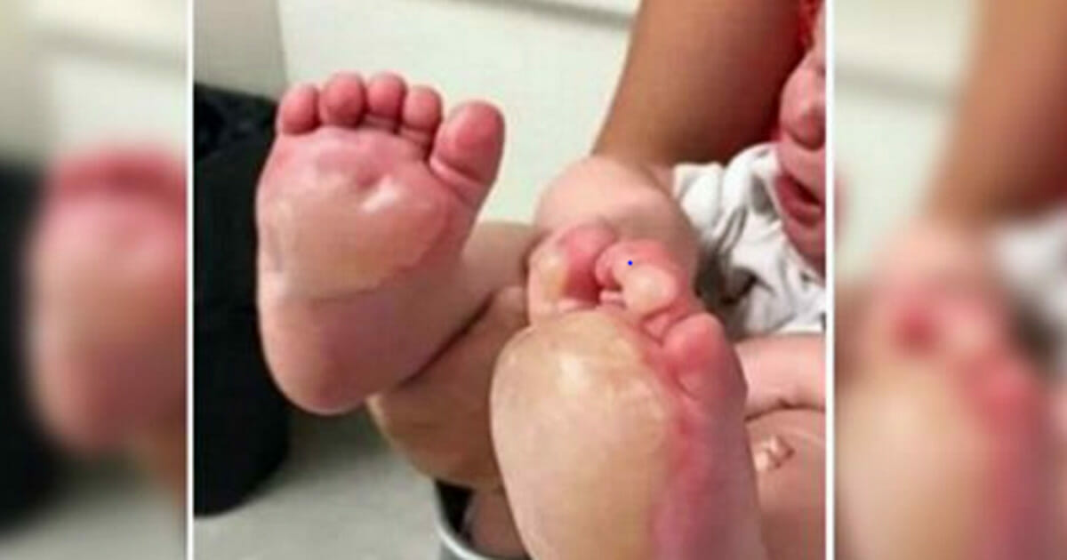 Maman Decouvre D Enormes Ampoules Sur La Plante Des Pieds Du Bebe Quelques Jours Plus Tard La Police Apprend Une Terrible Verite