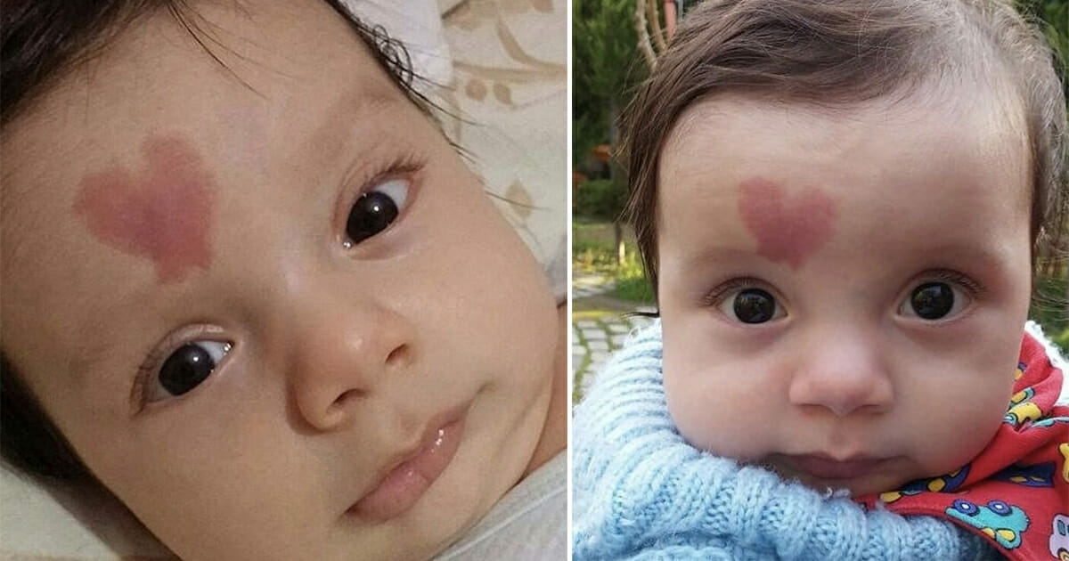 Bebe Avec Une Tache De Naissance Unique Charme Le Monde Entier